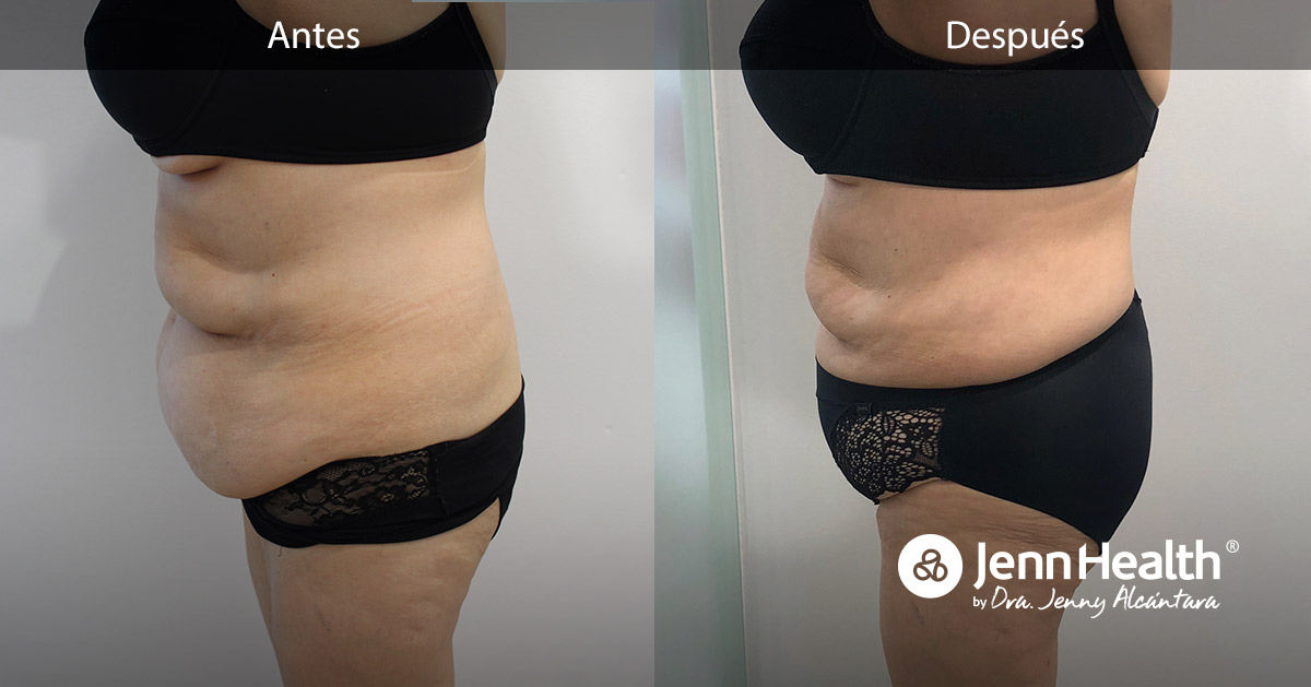 antes y despues de liposuccion sin cirugia